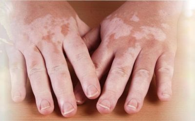 What is Skin Care Vitiligo (Leucoderma)? Explains Dermatologist