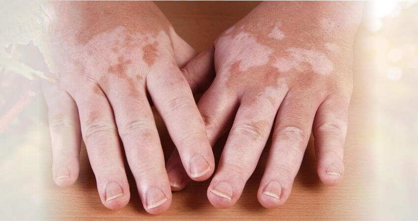 What is Skin Care Vitiligo (Leucoderma)? Explains Dermatologist