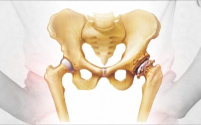 Total Hip Replacement