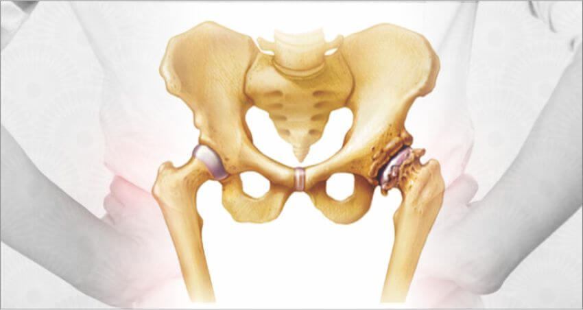 Total Hip Replacement