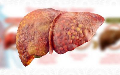 ON WORLD CIRRHOSIS DAY- 10 POINTS ON THE LIVER DISEASES