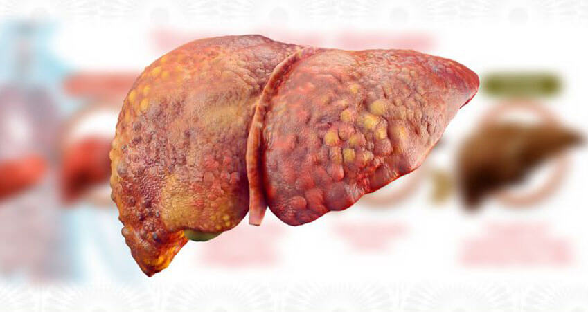 ON WORLD CIRRHOSIS DAY- 10 POINTS ON THE LIVER DISEASES