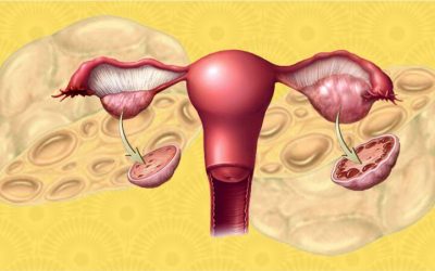 WHAT IS POLYCYSTIC OVARIAN SYNDROME (PCOS)?