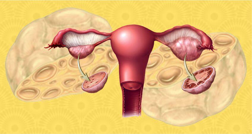 WHAT IS POLYCYSTIC OVARIAN SYNDROME (PCOS)?