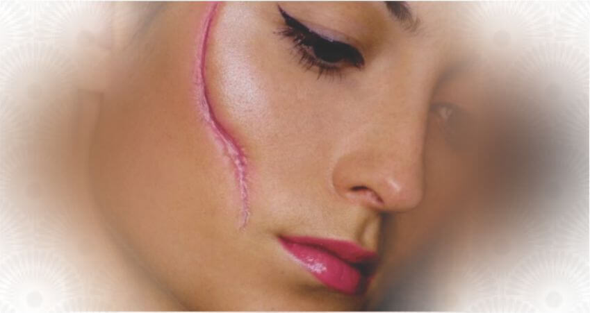 Why Scars??