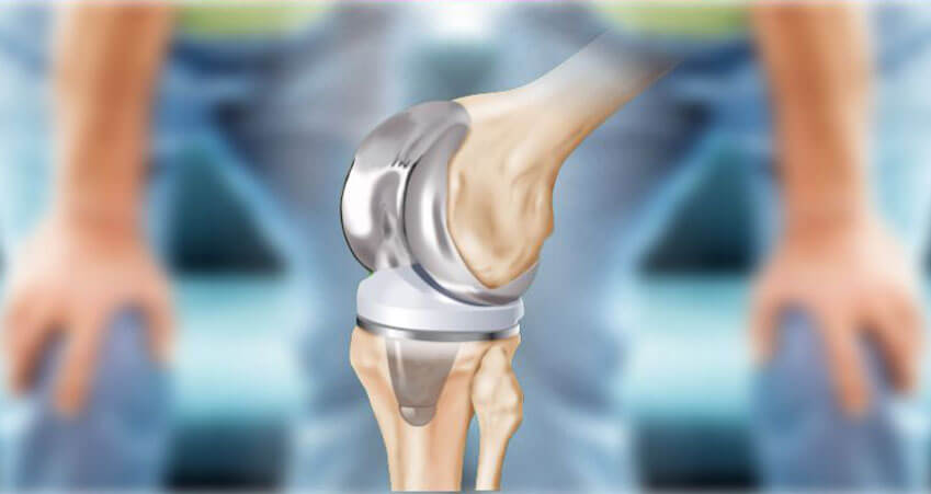 Joint Replacement Surgery A Successful Treatment