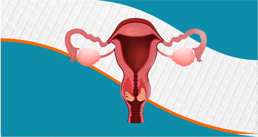 What Is Cervical Cancer?
