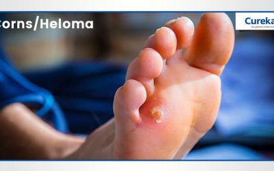 Corns / Heloma