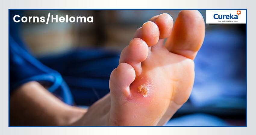 Corns / Heloma