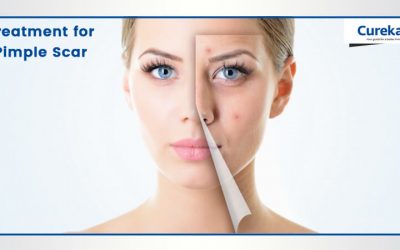 Treatment for Pimple Scar