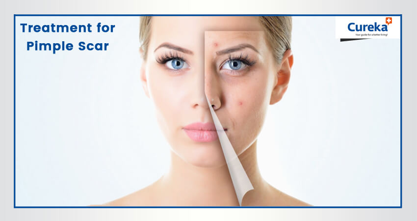 Treatment for Pimple Scar