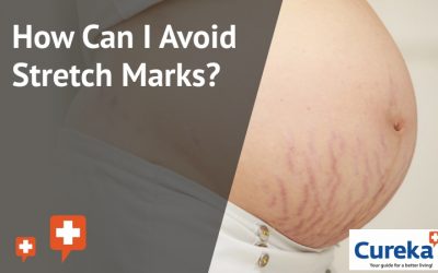 How Can I Avoid Stretch Marks?
