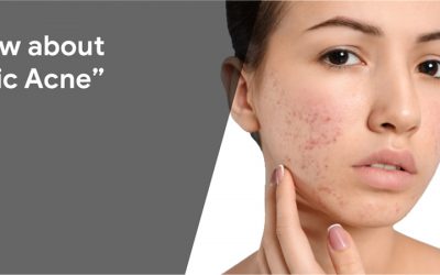 Know about Cystic Acne