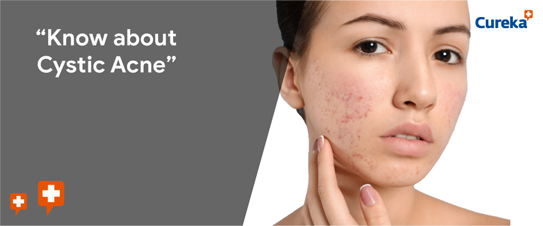 Know about Cystic Acne