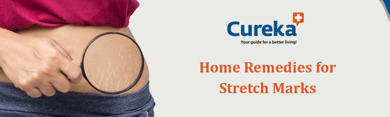 Home remedies for stretch marks