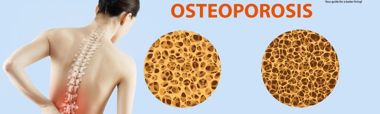 Osteoporosis