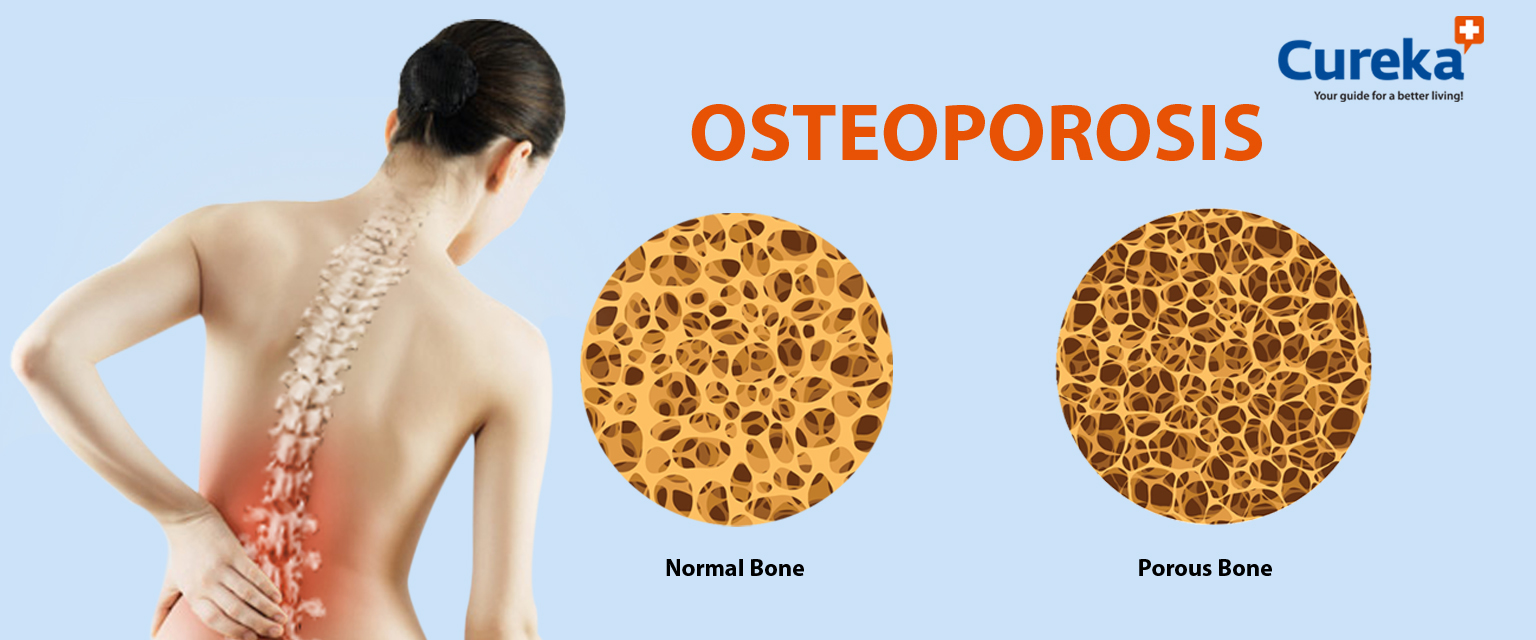Osteoporosis