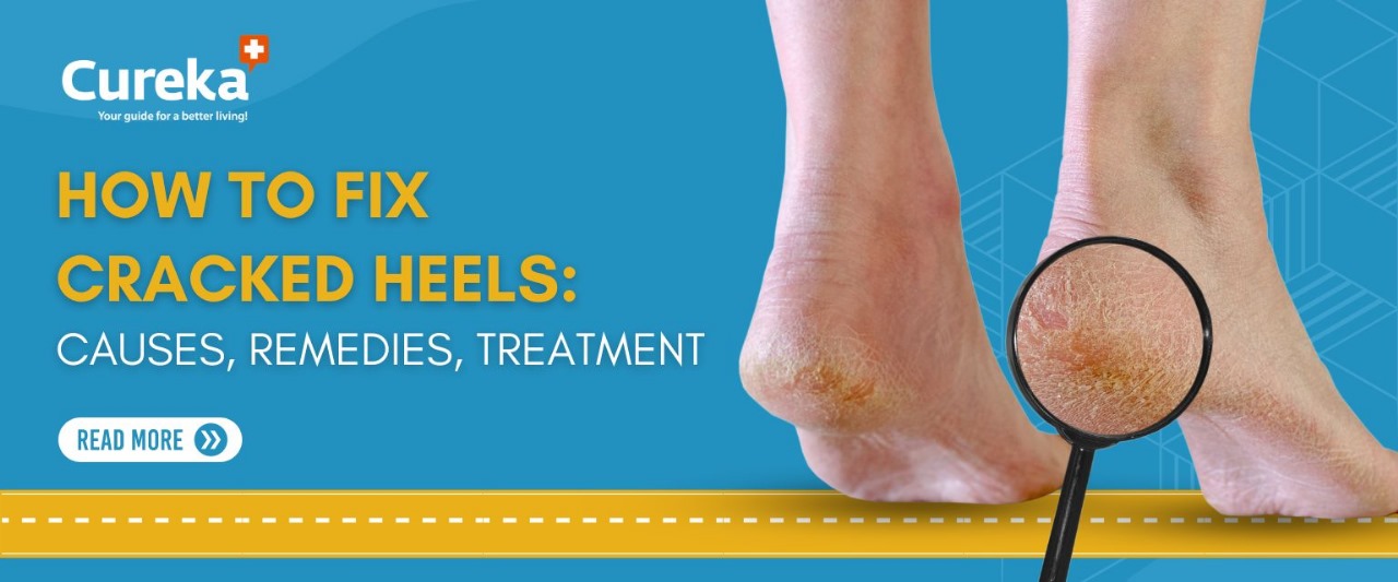 How To Fix Cracked Heels: Causes, Remedies, Treatment